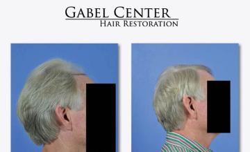 Before and after hair transplant procedure images