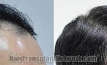 Hair transplantation surgery before and after pictures