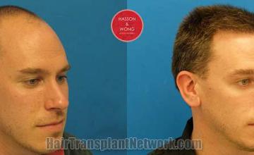 Hair transplantation surgery before and after images