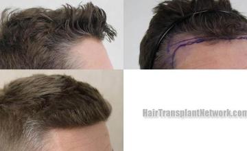 Hair transplantation surgery before and after images