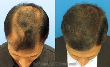 Top view before and after hair restoration results