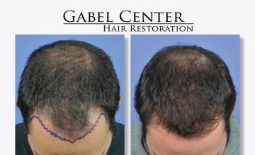 Top view - Before and after surgical hair replacement