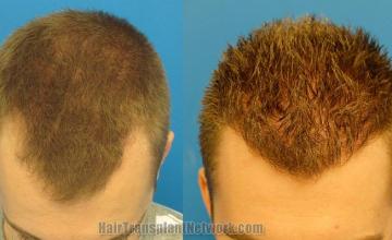 Hair transplantation surgery before and after photos