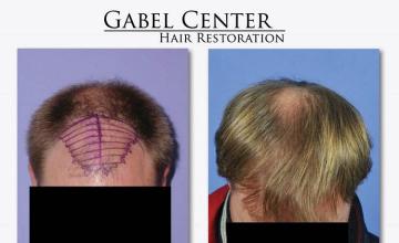 Top view before and after hair restoration results