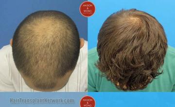 Hair transplantation surgery before and after photos