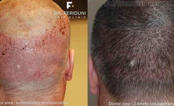 Donor area showing before and after hair transplant