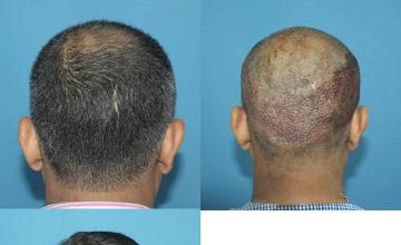 Hair replacement surgery before and after images