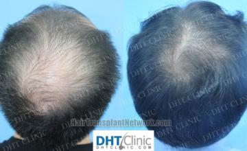 Hair replacement surgery before and after images