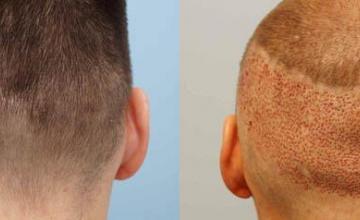 Hair transplant surgery before and after images