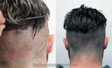 Hair restoration procedure before and after pictures