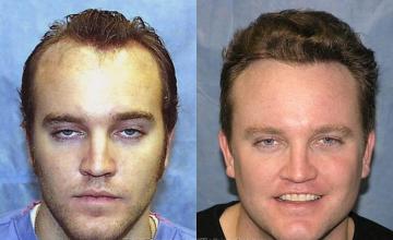 Hair restoration procedure before and after results