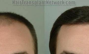 Hair transplantation surgery before and after pictures