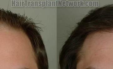 Before and after hair transplant procedure images