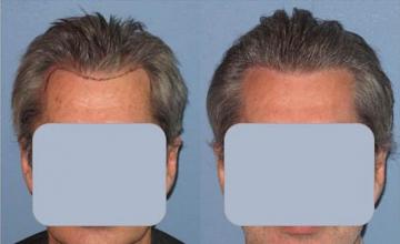 Front view - Before and after hair transplantation surgery