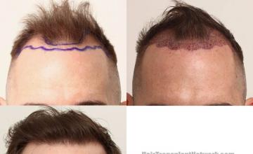 Front view - Before and after hair restoration procedure