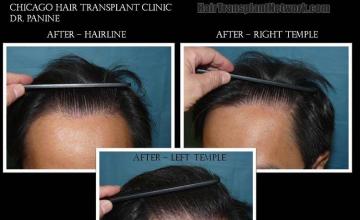 After photos showing closeup views of hairlines