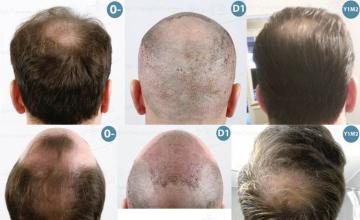 Surgical hair transplantation result photographs