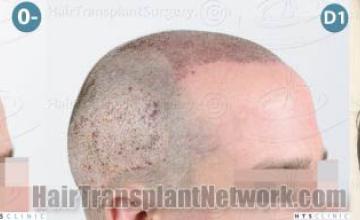  before and after photos