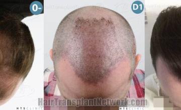Hair transplantation surgery before and after images