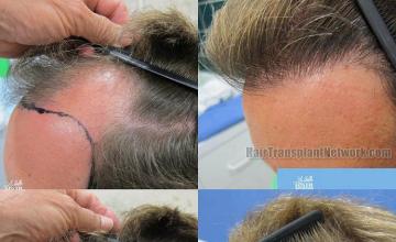 Hair transplantation surgery before and after images