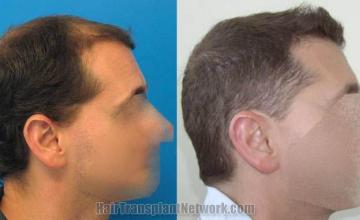 Hair restoration procedure before and after results