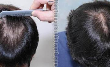 Top view before and after hair restoration results