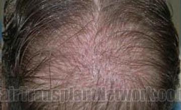 Variety of intraoperative photos from hair transplant