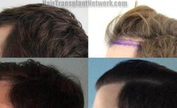 Hair transplantation surgery before and after pictures