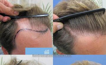 Hair transplantation surgery before and after photos