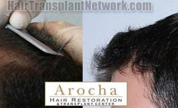 Hair transplantation surgery before and after pictures