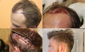 Hair transplantation surgery before and after pictures