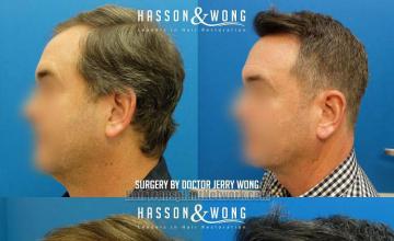 Hair transplantation surgery before and after photos