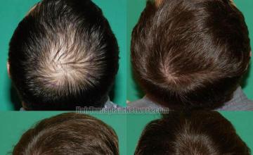 Hair transplantation surgery before and after photos