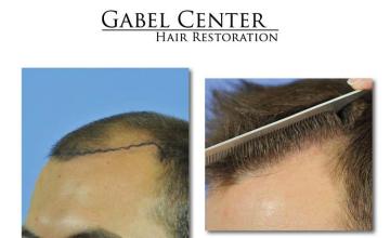 Hair transplantation surgery before and after images