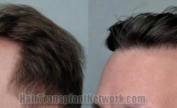 Hair transplantation surgery before and after images