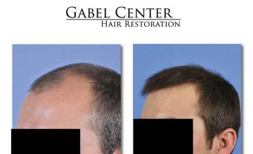 Hair restoration procedure before and after pictures