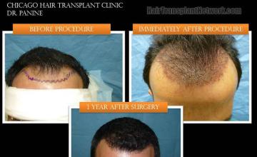 Hair transplant surgery before and after pictures