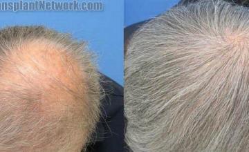 Before and after photos of  hair transplant to the crown