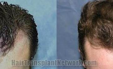 Hair transplantation surgery before and after photos
