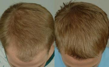 Hair transplantation surgery before and after pictures