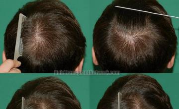 Hair transplantation surgery after images