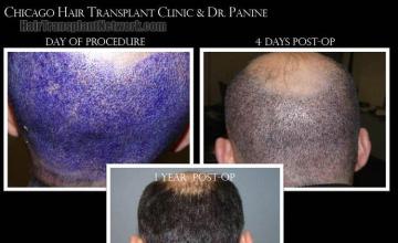 Hair transplantation surgery before and after pictures