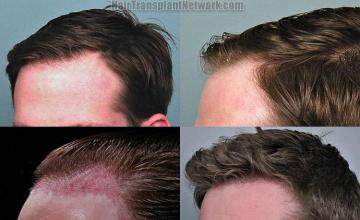 Hair transplantation surgery before and after pictures