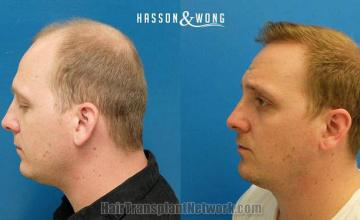 Hair transplantation surgery before and after photos