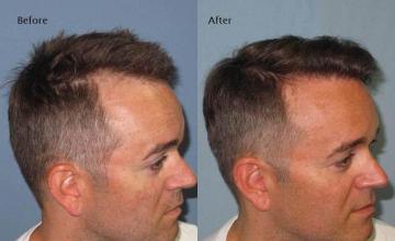 Hair transplantation surgery before and after photos