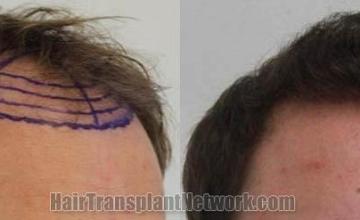 Hair transplantation surgery before and after photos