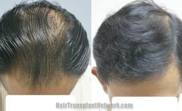 Top view before and after hair restoration procedure