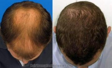 Top view before and after hair restoration results