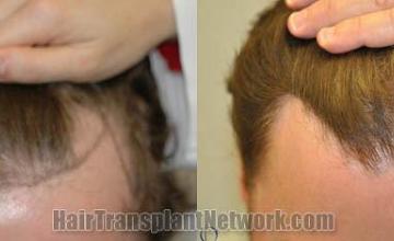 Hair restoration procedure before and after results