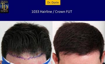 Hair transplantation surgery before and after pictures